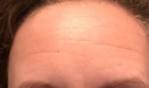 Close-up of a person's forehead with visible lines and skin texture.