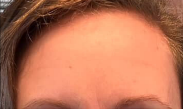 Close-up of a person's forehead with visible skin texture and hair.
